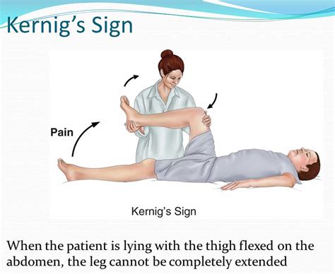 signs for meningitis kernig sign